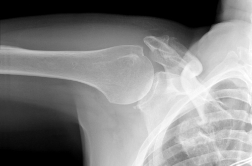 Brutet nyckelben – orsak, symtom & behandling